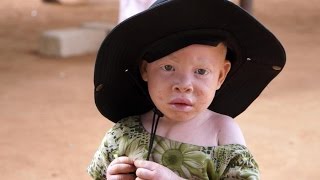 L’Afrique albinos