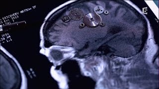 Accidents vasculaires cérébraux, les bons réflexes