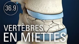 Ostéoporose : le remède peut être pire que le mal