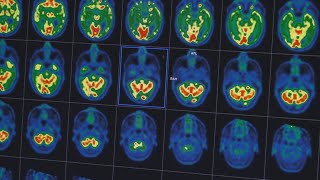Alzheimer : comment lutter contre la maladie ?
