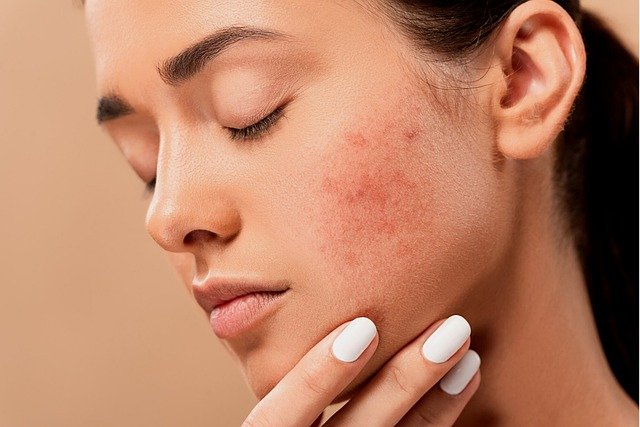 Quelles sont les maladies de peau que l’on rencontre souvent ?