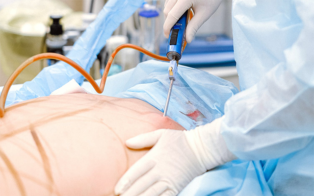 Ma liposuccion
