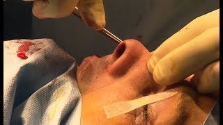 Rhinoplastie : une chirurgie impressionnante