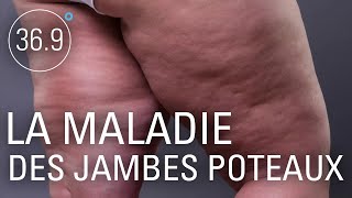 Méconnue et douloureuse : la maladie des jambes poteaux