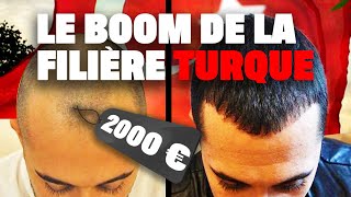 Documentaire Greffe de cheveux : le boom de la filière turque