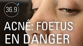 Prescriptions contre l'acné : le scandale continue!
