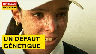 La maladie des enfants de la lune - une vie sous haute protection