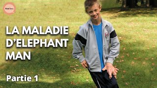 Documentaire Mon fils a la maladie d’Elephant Man | Partie 1