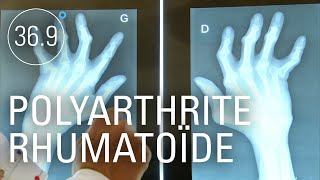 Documentaire Pour que la polyarthrite rhumatoïde ne dévore plus les articulations