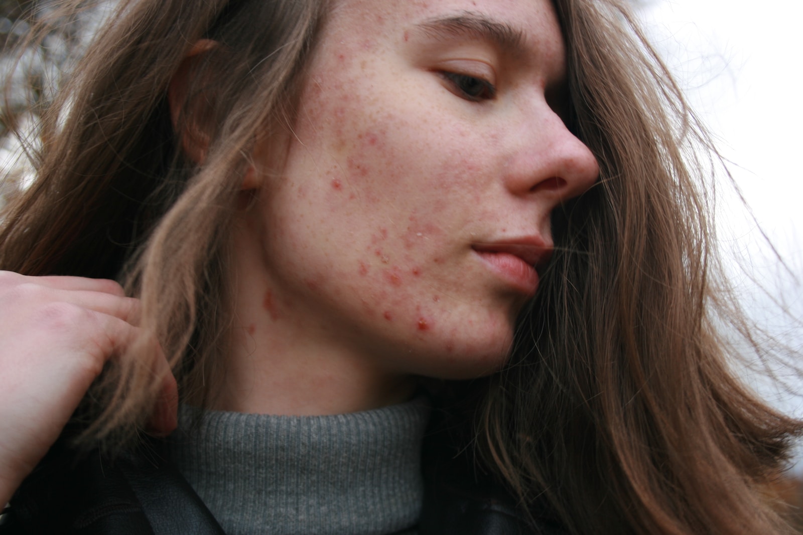 Documentaire Tout savoir sur l’acné