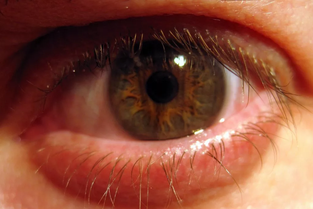 Documentaire Rosacée oculaire : comment la soigner ?