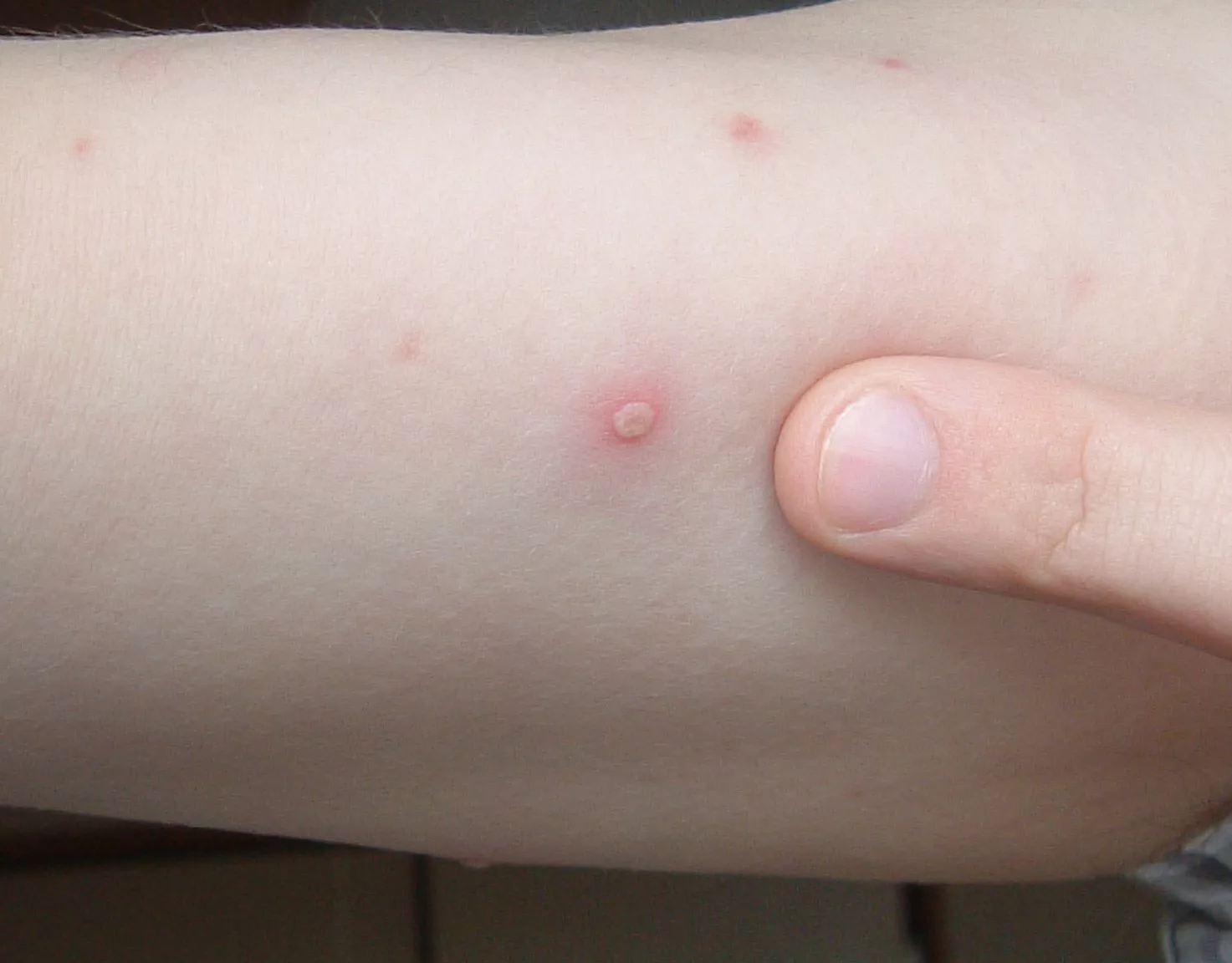 Documentaire Tout sur la varicelle