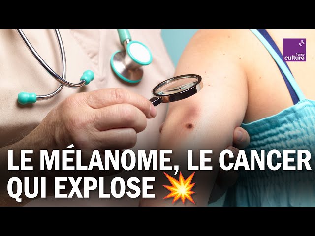 Mélanome : les nouveaux espoirs contre un cancer agressif