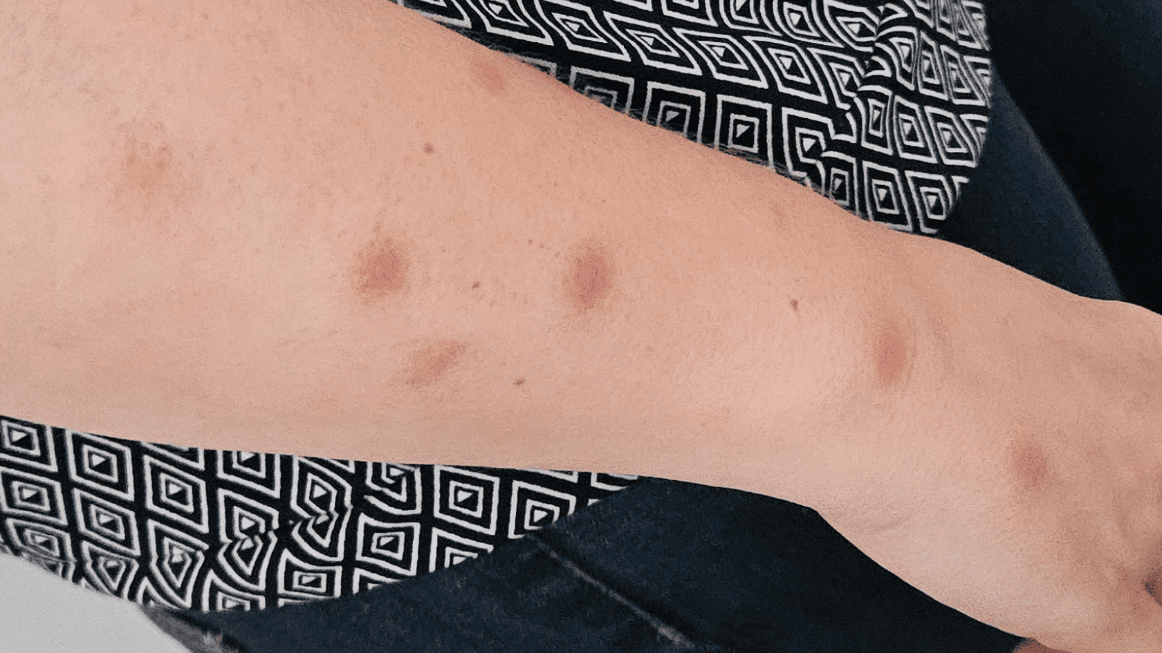 Piqûres de punaises de lit : comment les soigner vraiment (et éviter les erreurs qui empirent la situation)