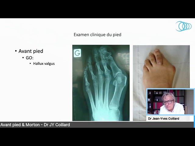 Pathologies de l'avant-pied
