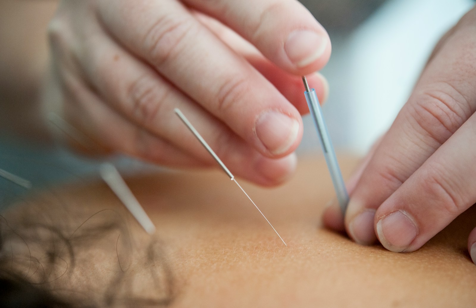 Acupuncture et médecine alternative : quel est l'avis scientifique ?