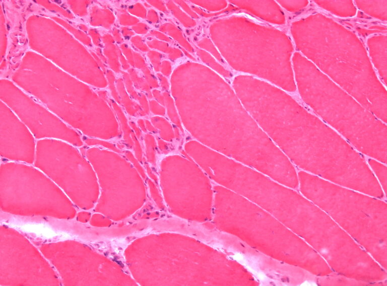 Article | Les effets des statines sur les muscles et les solutions possibles